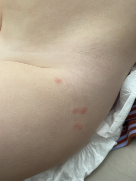 Help! Is this chicken pox?