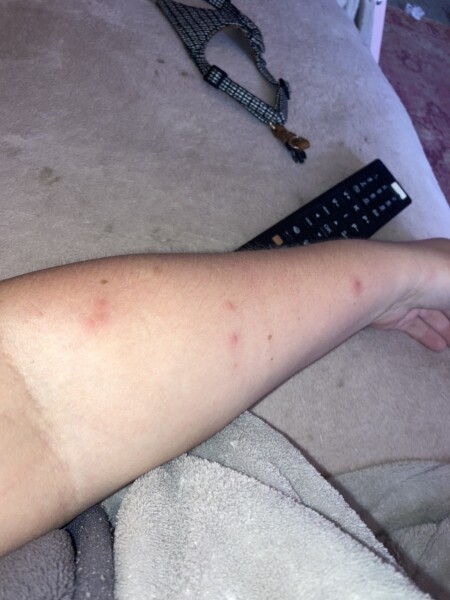 To be worried about this rash?