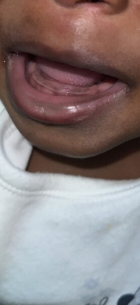 9 month old split gum, teething?