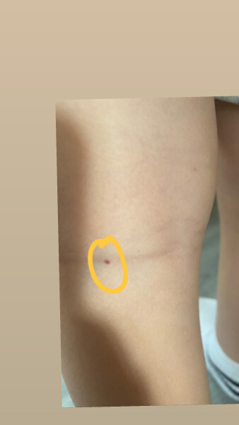 Mark on sons leg ?