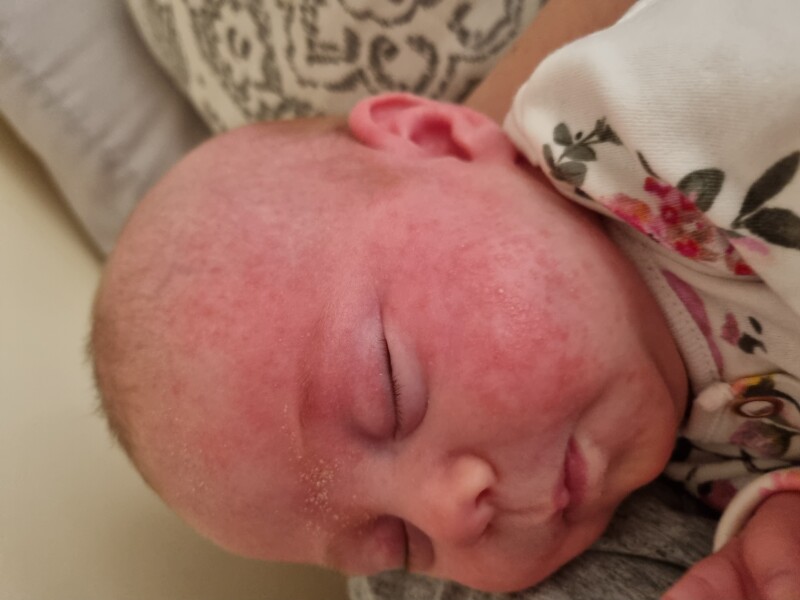 Baby acne