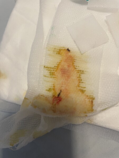 AIBU to go A and E ? Photo warning 