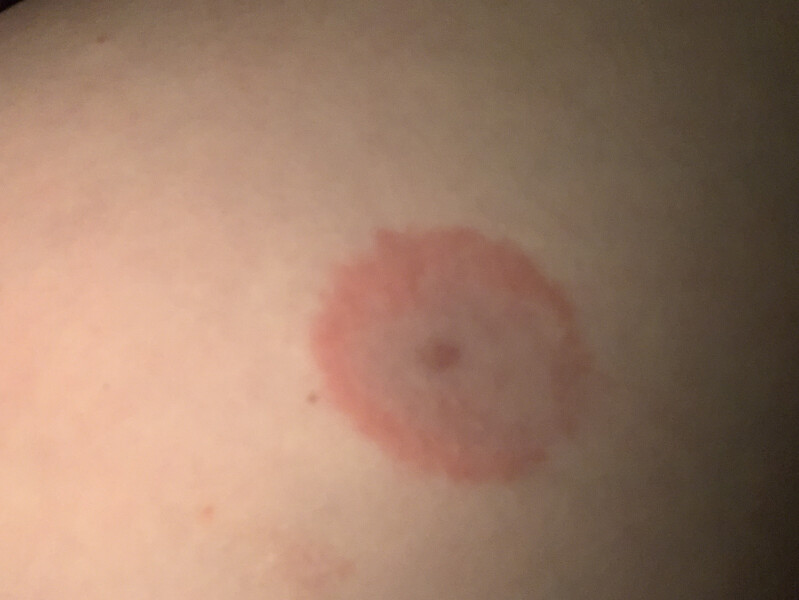Insect bite flare up advice needed (with photo)
