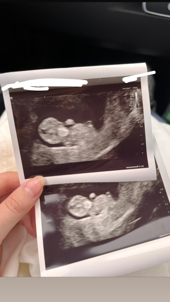 Have I had a miscarriage 10 weeks? *Content warning - graphic photograph*
