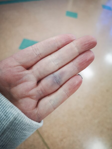Achenbach syndrome - help, please!