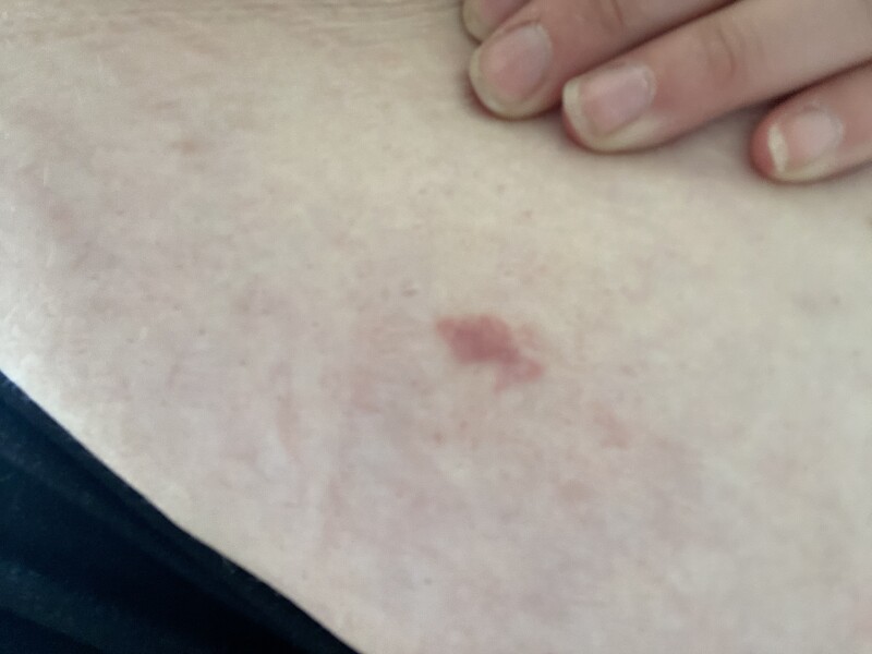 What is biting me?! With pics 