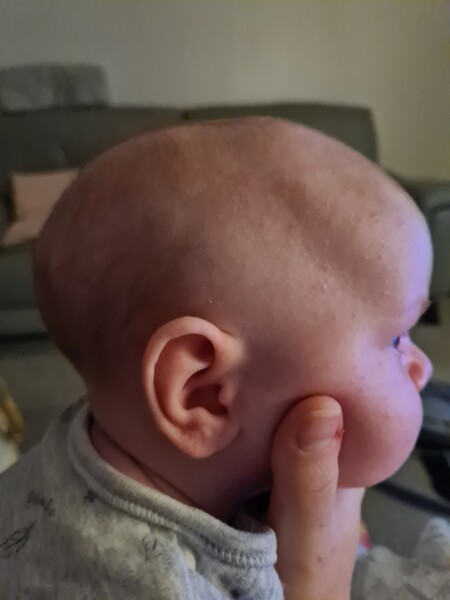 Anyone have experience with Sagittal craniosynostosis?