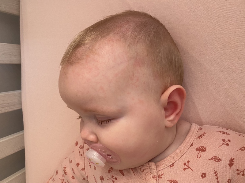 New rash on baby’s head, scalp and chest - pics 