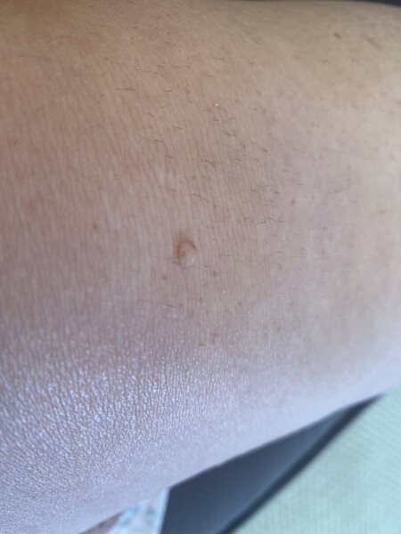 Lump on knee