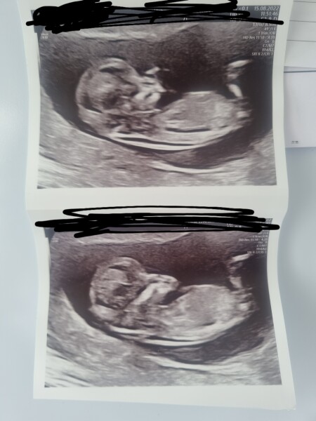 Anyone guess the gender of my 12 weeks scan?