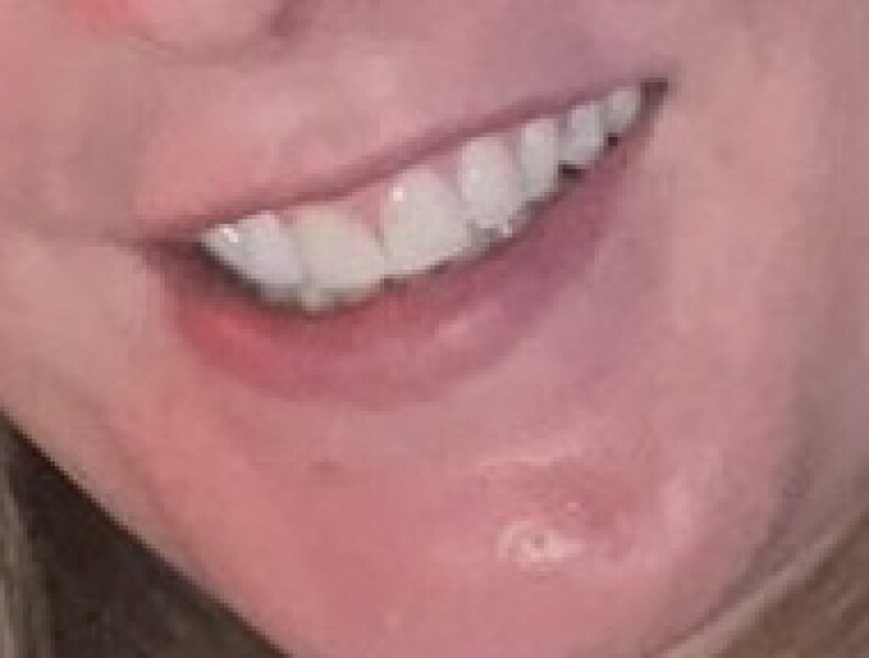 To ask for handhold with Invisalign?
