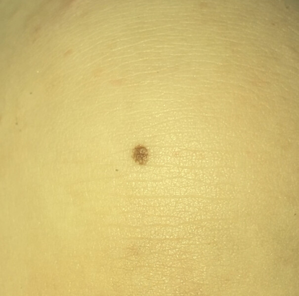 One year olds mole? Normal?