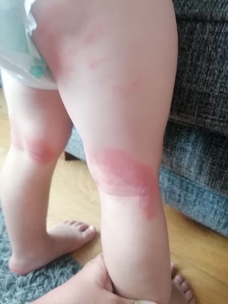 Dairy intolerance. Skin issues 