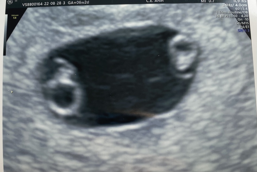 Twin ultrasound @ 6w+2