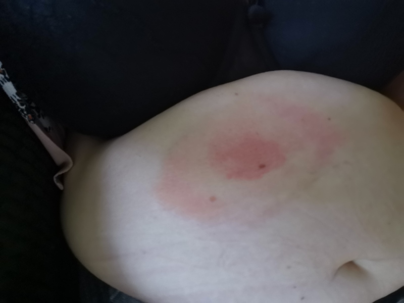 Insect bite -  strange rash??? 