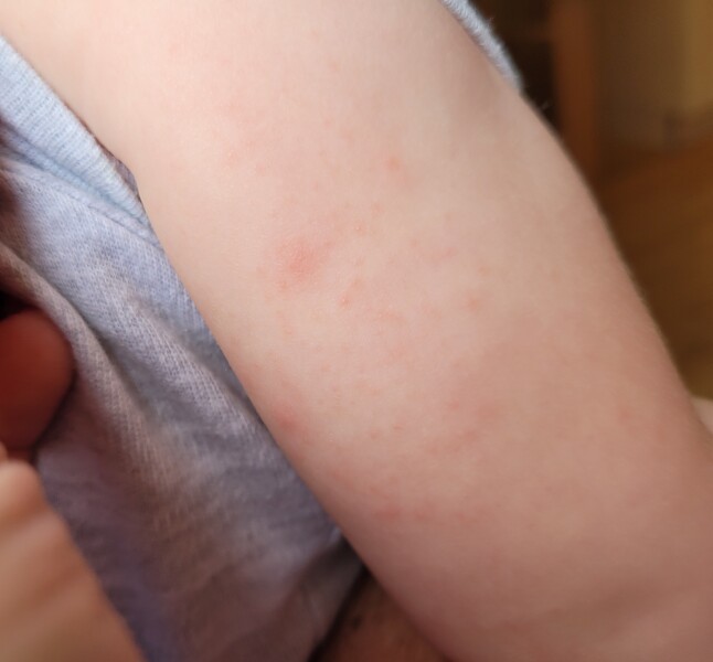 What does a fooofd allergy rash look like?