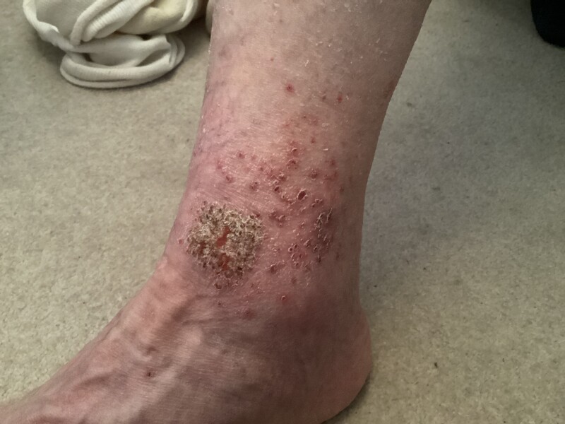 To ask if you can identify this rash?