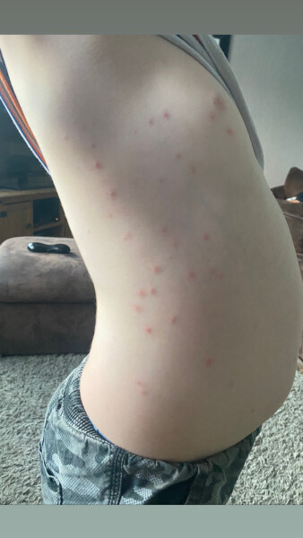 Does this look like chickenpox?
