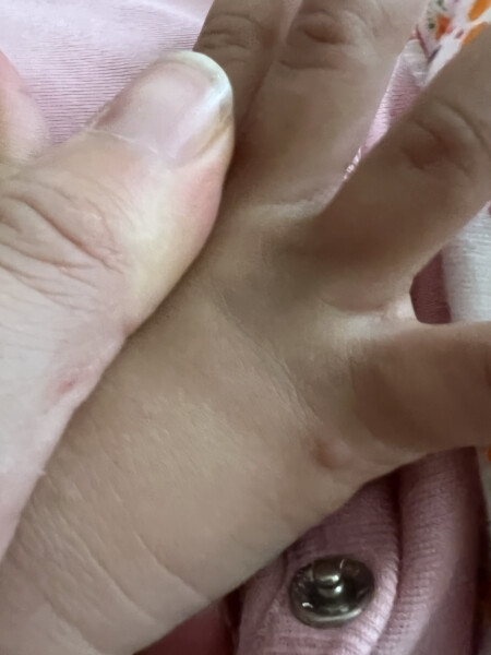Are these chicken pox ?
