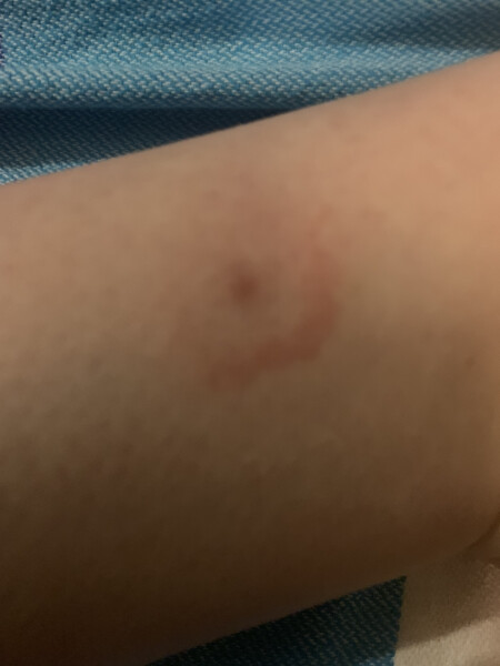 Insect bite flare up advice needed (with photo)