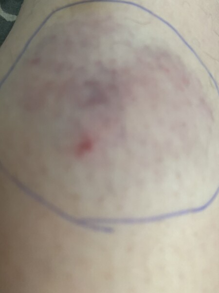 Am I gonna need a tetanus ? Dog bite (pics included )