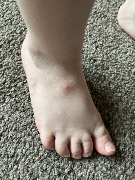 Possible Lyme disease - 4 year old DS