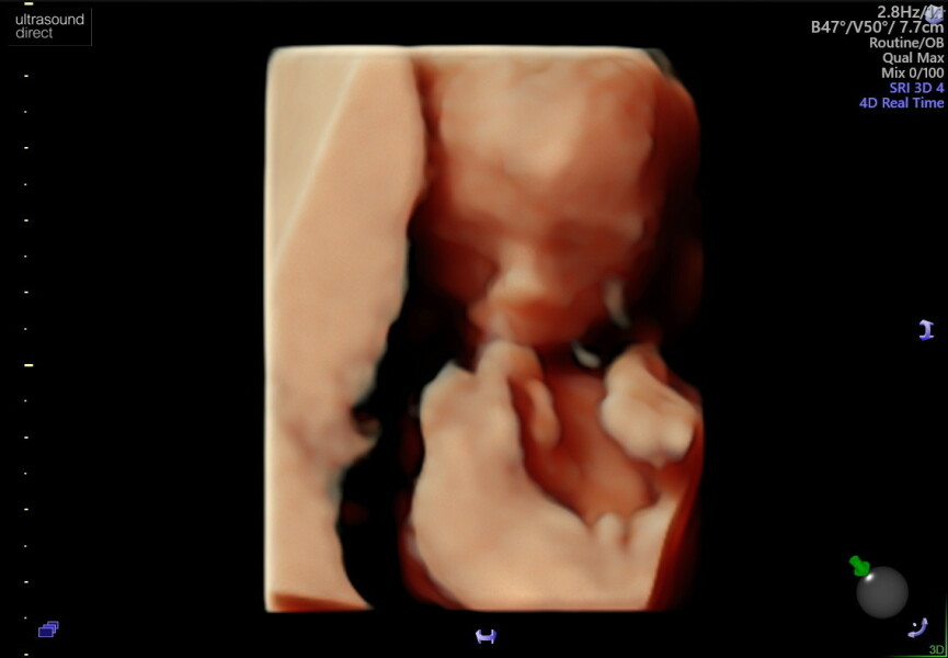 Navigating pregnancy after loss thread 4!