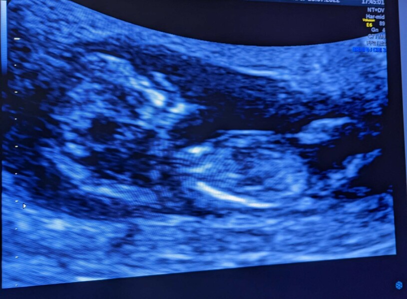 Boy or girl? Any nub theory experts?
