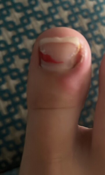 Dd toe. Is this infected?