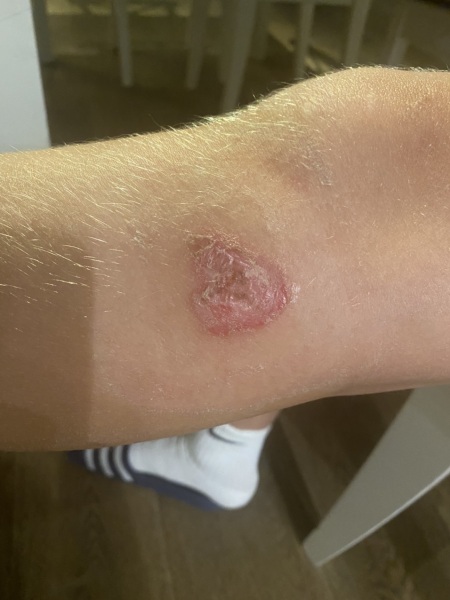 Sore on leg (picture included)