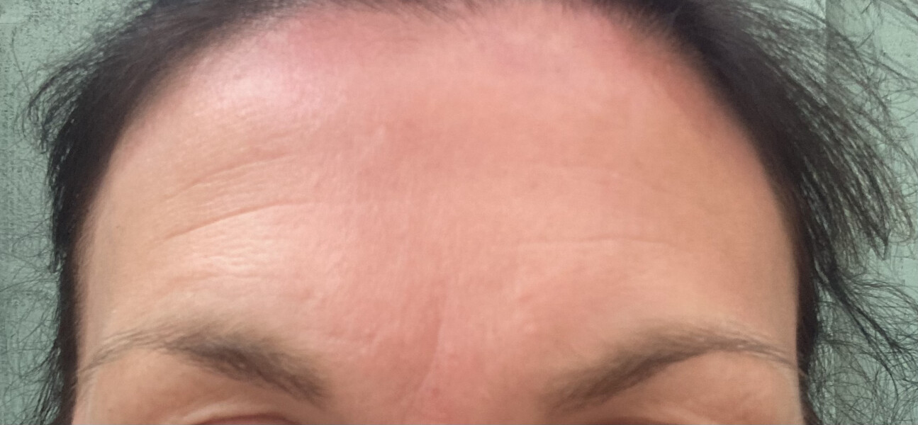 My forehead , out of interest