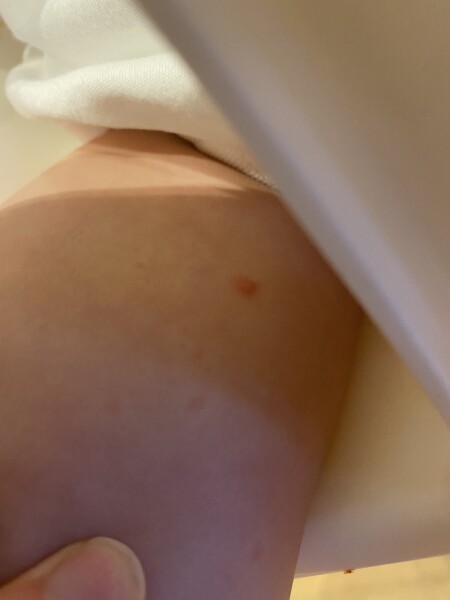 Is this chicken pox?! 