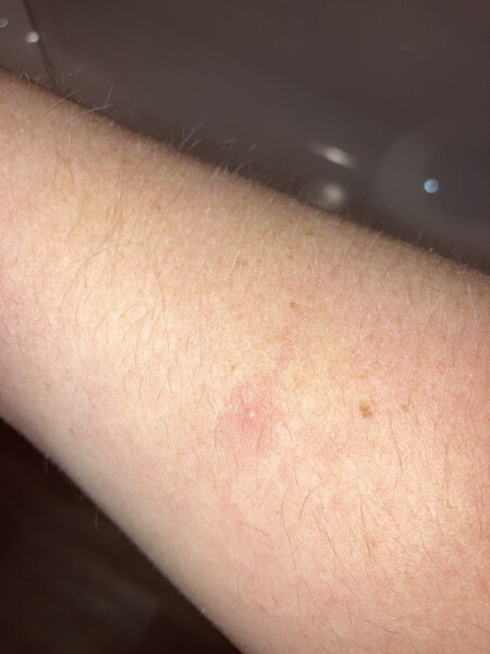 To be worried about this rash?