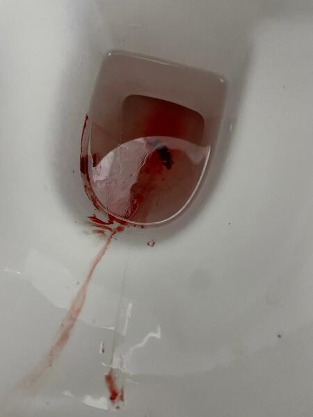 Have I had a miscarriage 10 weeks? *Content warning - graphic photograph*