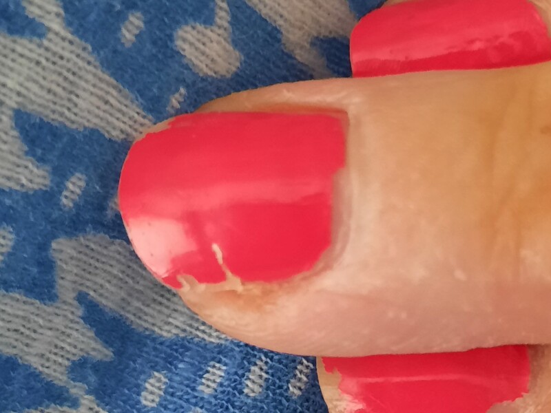 Ouch! My nail is splitting!
