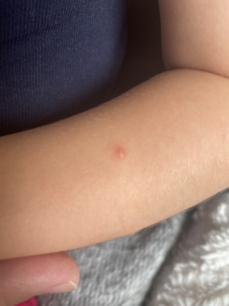 What are these lumps?