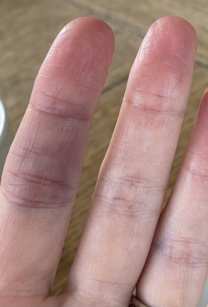 Achenbach syndrome - help, please!