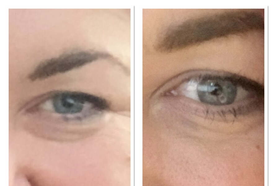 Has anyone managed to get rid of/reduce natural dark under eyes?