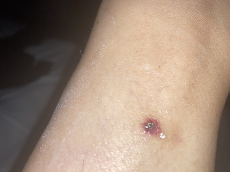 Infected?