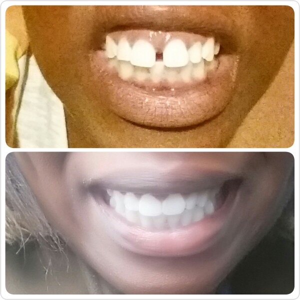To ask if you found Invisalign worth it? 