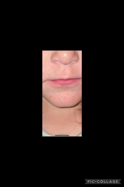 DD3 vomiting for 3 weeks