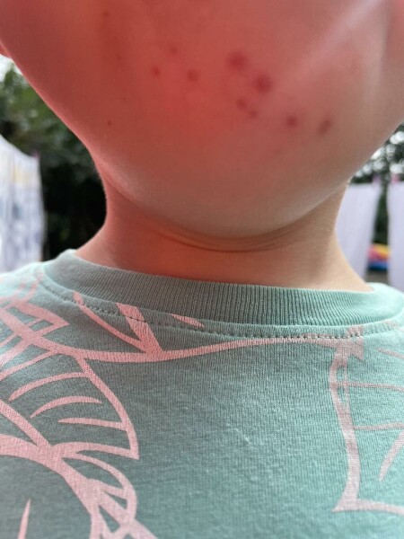 3 year old, same spots on chin for weeks