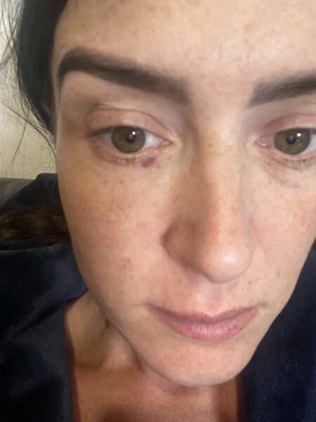 Broken blood vessels? 9 weeks pregnant 