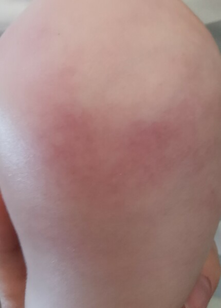 Marks on baby legs