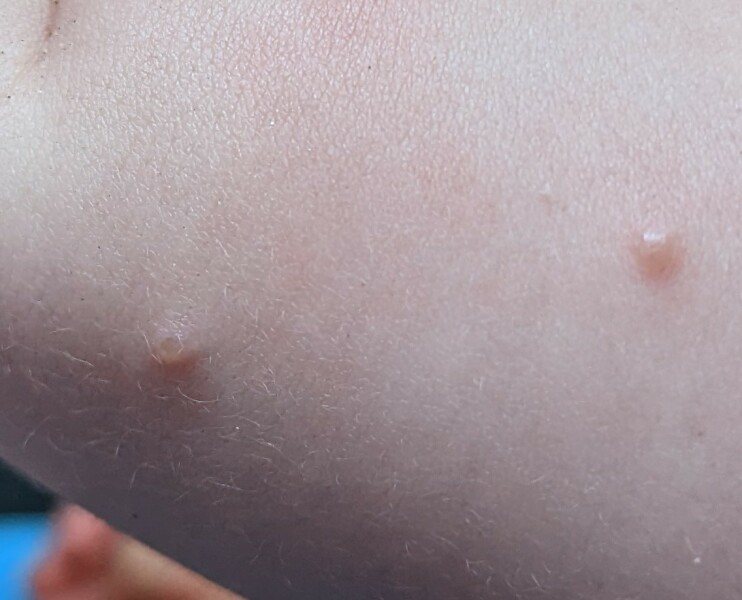 To ask about chickenpox?