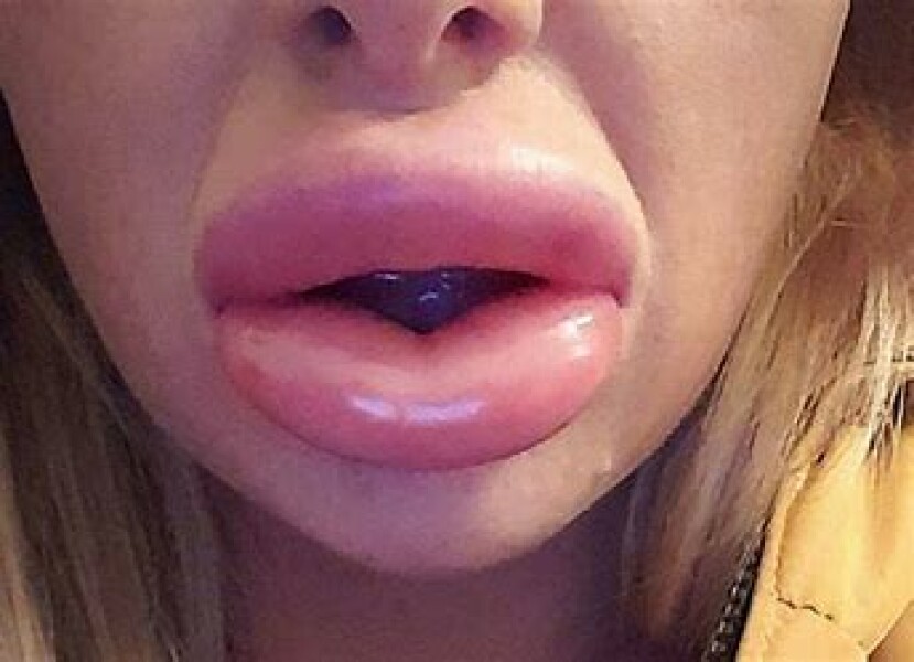 Bit of Filler... husband furious!