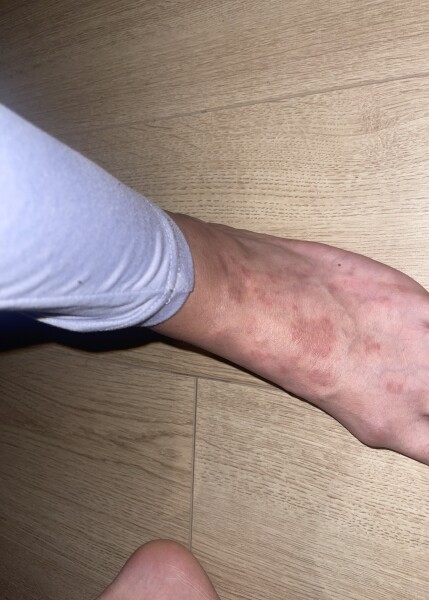 Unknown rash 