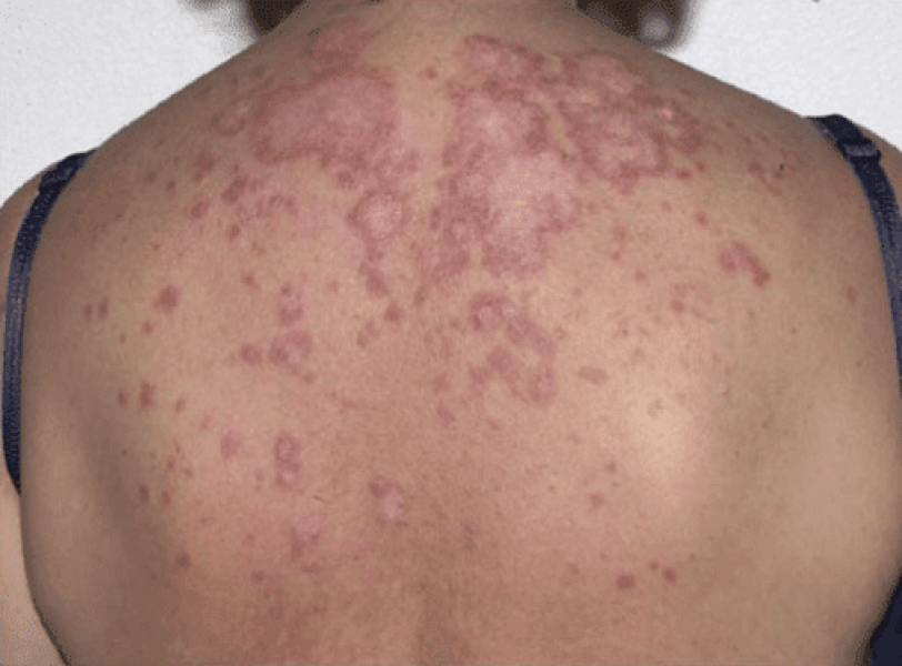 What is this rash? Pic