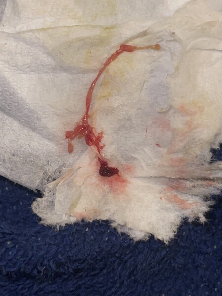 Could this be miscarriage tissue? GRAPHIC