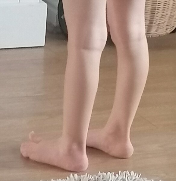 Hypermobility? 